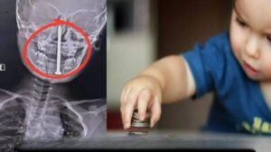 If a child swallows medicine or a coin while playing, know what to do and what not to do?